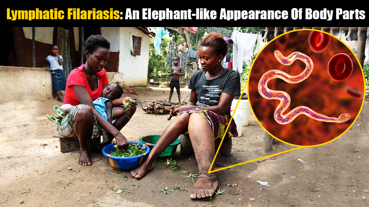 Elephantiasis/ Lymphatic Filariasis – My Disease Blog